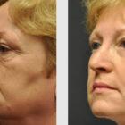 A Before and After photo of an Eyelid Lift Plastic Surgery by Dr. Craig Jonov in Seattle and Tacoma