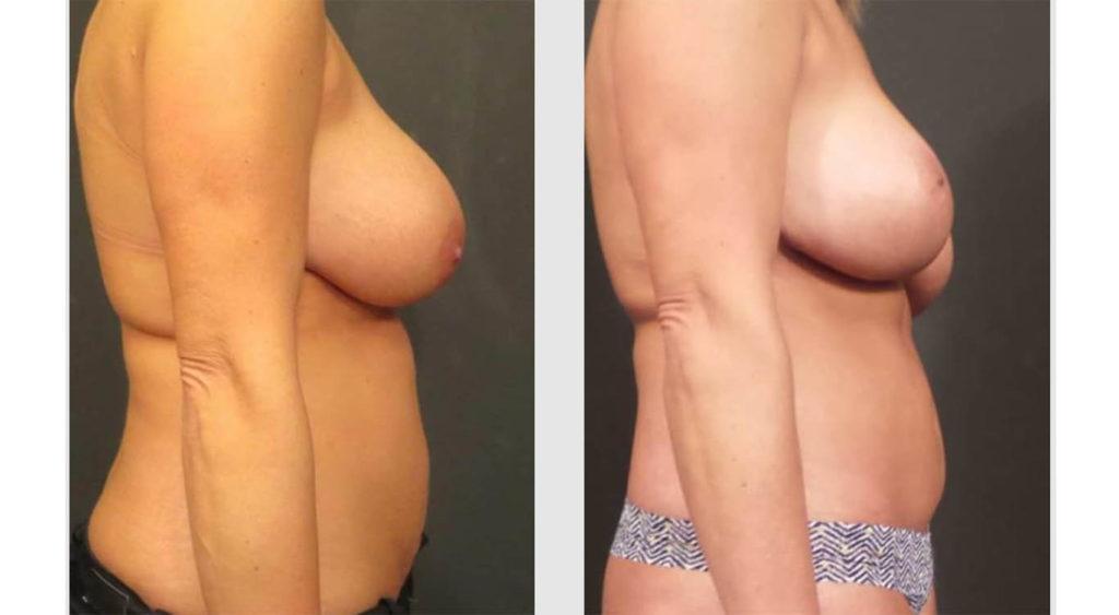 A Before and After photo of a Mommy Makeover Plastic Surgery by Dr. Craig Jonov in Seattle and Tacoma