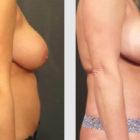 A Before and After photo of a Mommy Makeover Plastic Surgery by Dr. Craig Jonov in Seattle and Tacoma