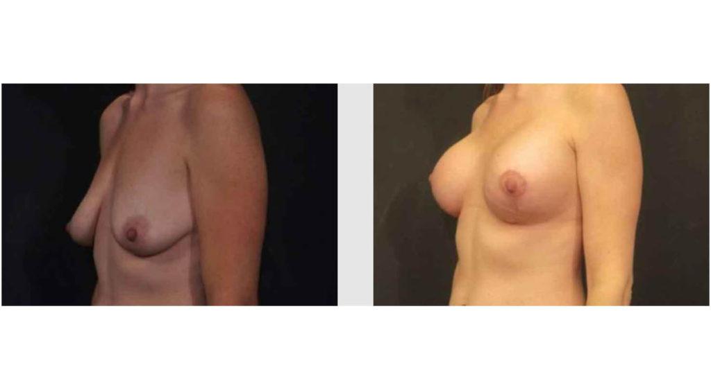 A Before and After photo of a Breast Lift Plastic Surgery by Dr. Craig Jonov in Seattle and Tacoma