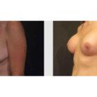 A Before and After photo of a Breast Lift Plastic Surgery by Dr. Craig Jonov in Seattle and Tacoma