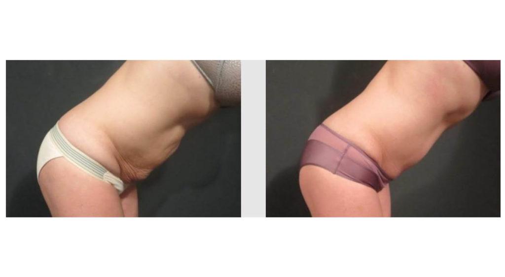 A Before and After photo of a Tummy Tuck Plastic Surgery by Dr. Craig Jonov in Seattle and Tacoma