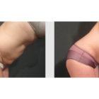 A Before and After photo of a Tummy Tuck Plastic Surgery by Dr. Craig Jonov in Seattle and Tacoma