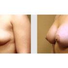 A Before and After photo of a Breast Lift Plastic Surgery by Dr. Craig Jonov in Seattle and Tacoma