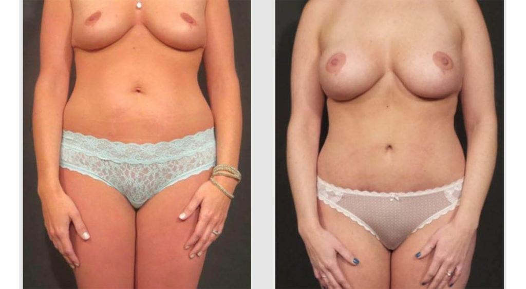 A Before and After photo of a Mommy Makeover Plastic Surgery by Dr. Craig Jonov in Seattle and Tacoma