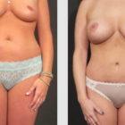 A Before and After photo of a Mommy Makeover Plastic Surgery by Dr. Craig Jonov in Seattle and Tacoma