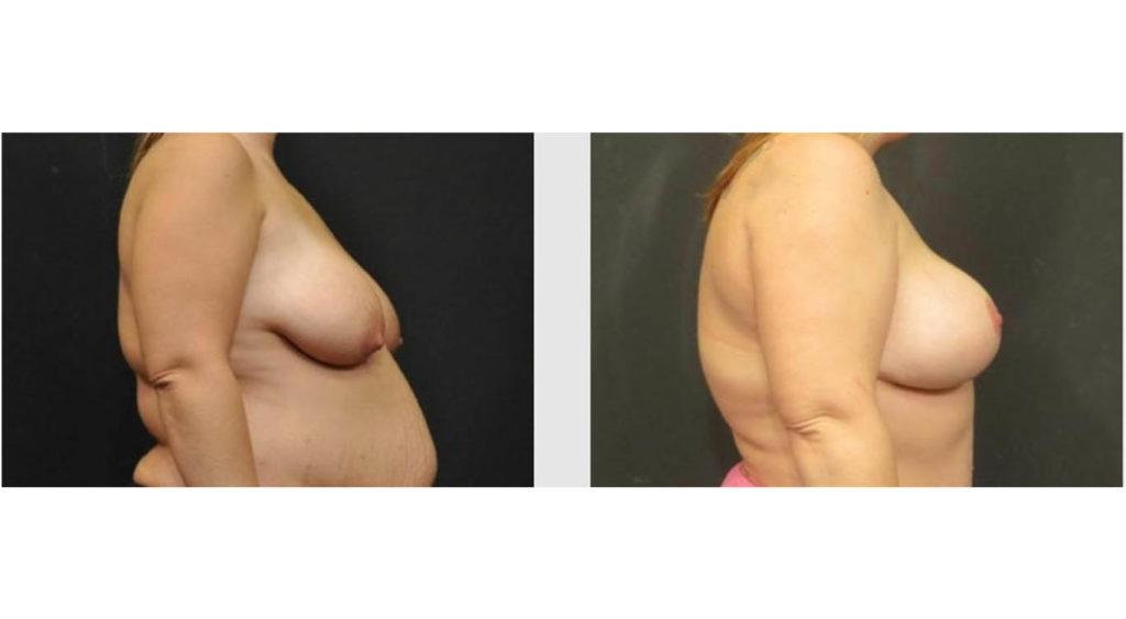 A Before and After photo of a Breast Lift Plastic Surgery by Dr. Craig Jonov in Seattle and Tacoma