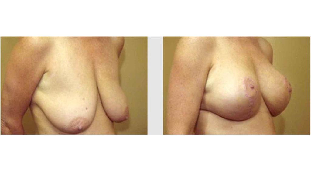 A Before and After photo of a Breast Lift Plastic Surgery by Dr. Craig Jonov in Seattle and Tacoma