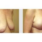 A Before and After photo of a Breast Lift Plastic Surgery by Dr. Craig Jonov in Seattle and Tacoma