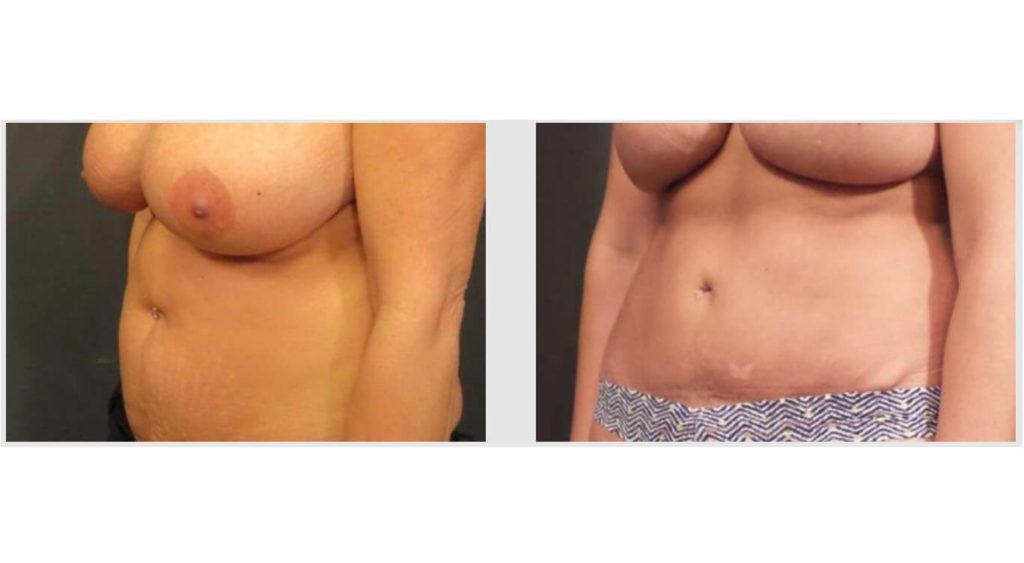 A Before and After photo of a Liposuction Plastic Surgery by Dr. Craig Jonov in Seattle and Tacoma