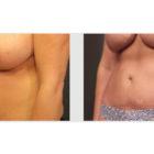 A Before and After photo of a Liposuction Plastic Surgery by Dr. Craig Jonov in Seattle and Tacoma