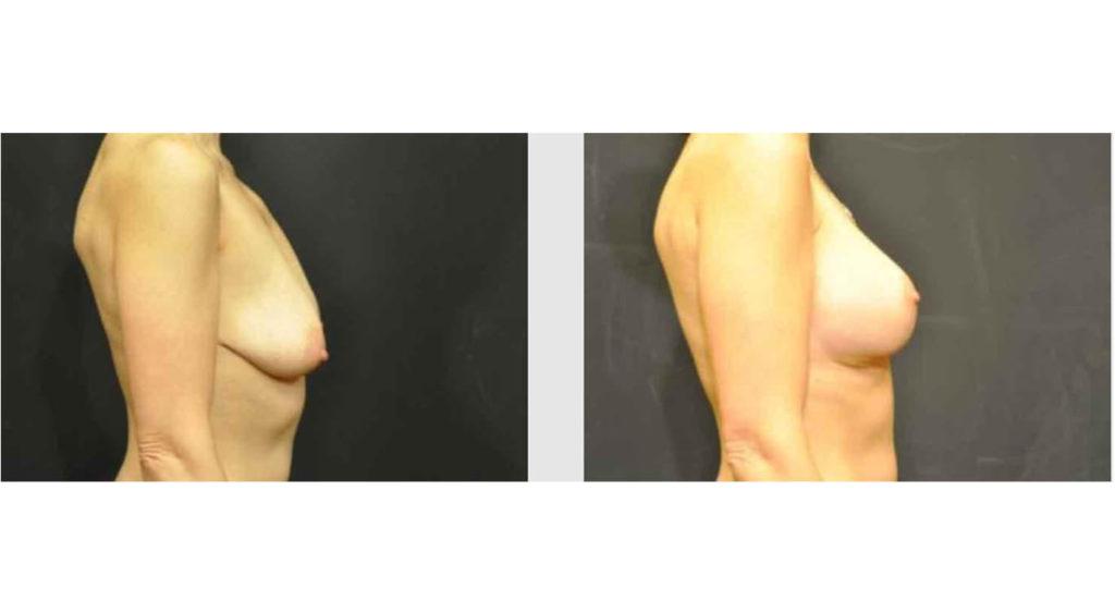 A Before and After photo of a Breast Lift Plastic Surgery by Dr. Craig Jonov in Seattle and Tacoma