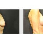 A Before and After photo of a Breast Lift Plastic Surgery by Dr. Craig Jonov in Seattle and Tacoma