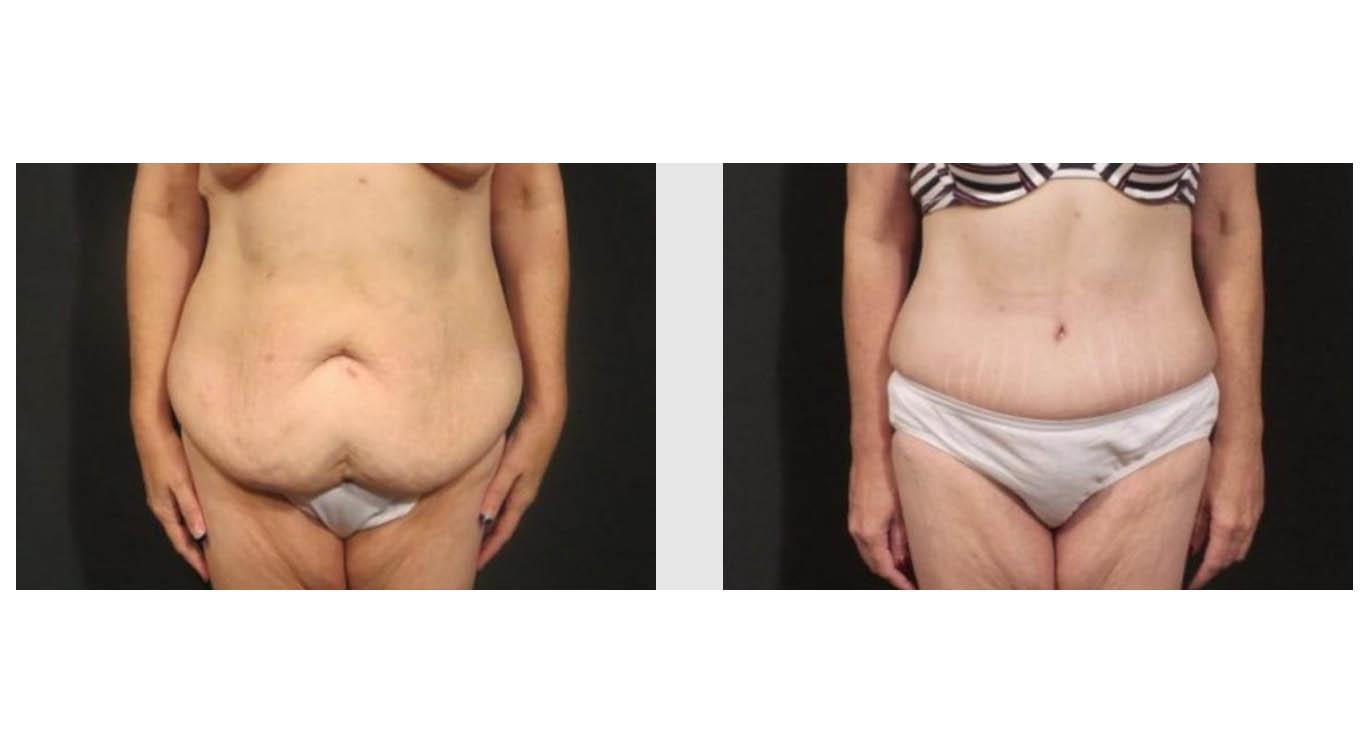 A Before and After photo of a Tummy Tuck Plastic Surgery by Dr. Craig Jonov in Seattle and Tacoma