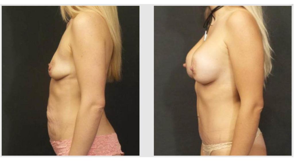A Before and After photo of a Mommy Makeover Plastic Surgery by Dr. Craig Jonov in Seattle and Tacoma