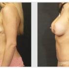 A Before and After photo of a Mommy Makeover Plastic Surgery by Dr. Craig Jonov in Seattle and Tacoma