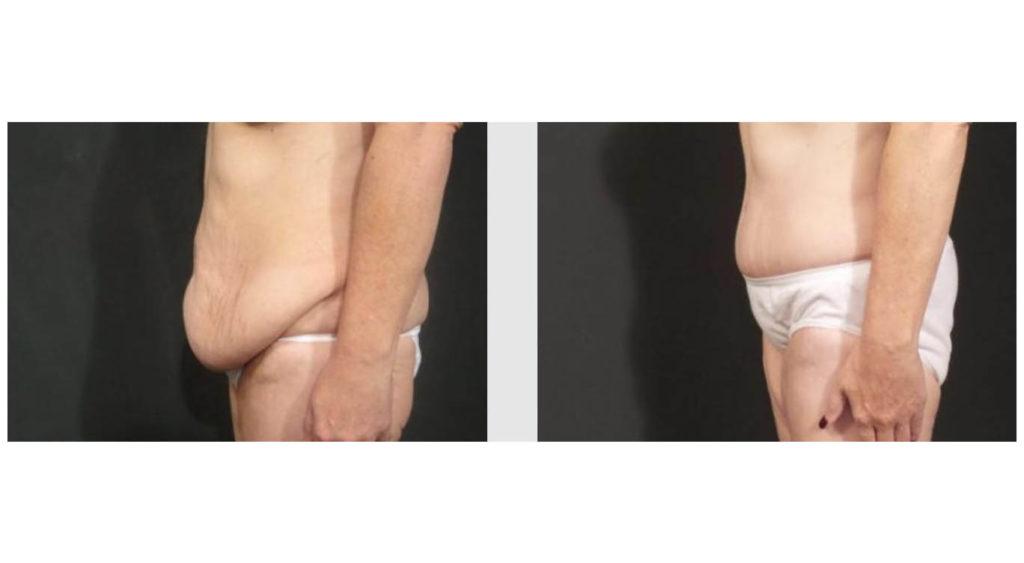 A Before and After photo of a Tummy Tuck Plastic Surgery by Dr. Craig Jonov in Seattle and Tacoma