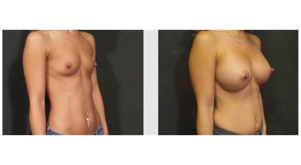 A Before and After photo of a Breast Augmentation Plastic Surgery by Dr. Craig Jonov in Seattle and Tacoma