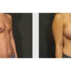 A Before and After photo of a Breast Augmentation Plastic Surgery by Dr. Craig Jonov in Seattle and Tacoma