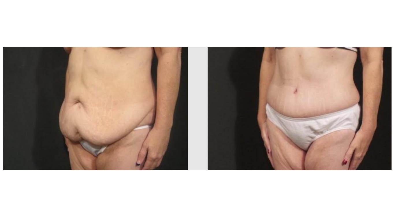 A Before and After photo of a Tummy Tuck Plastic Surgery by Dr. Craig Jonov in Seattle and Tacoma