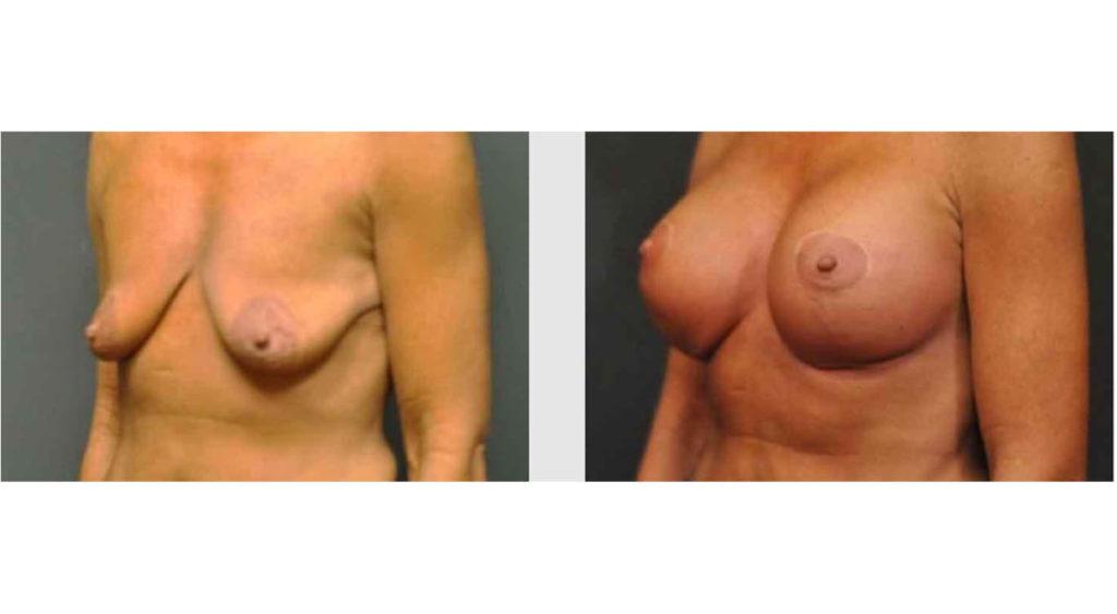 A Before and After photo of a Breast Lift Plastic Surgery by Dr. Craig Jonov in Seattle and Tacoma