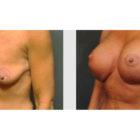 A Before and After photo of a Breast Lift Plastic Surgery by Dr. Craig Jonov in Seattle and Tacoma