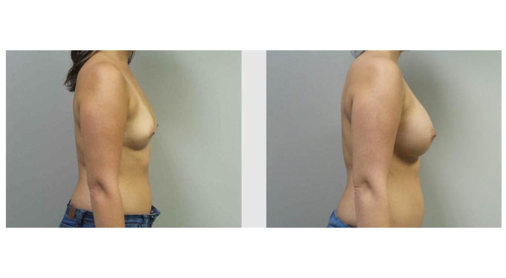 A Before and After photo of a Breast Augmentation Plastic Surgery by Dr. Craig Jonov in Seattle and Tacoma