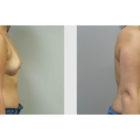 A Before and After photo of a Breast Augmentation Plastic Surgery by Dr. Craig Jonov in Seattle and Tacoma