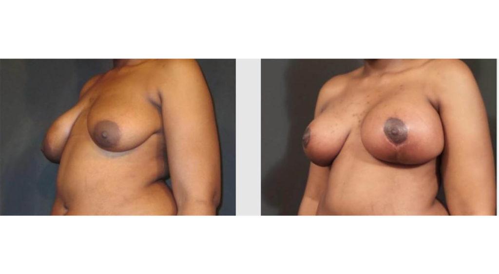 A Before and After photo of a Breast Lift Plastic Surgery by Dr. Craig Jonov in Seattle and Tacoma