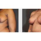 A Before and After photo of a Breast Lift Plastic Surgery by Dr. Craig Jonov in Seattle and Tacoma