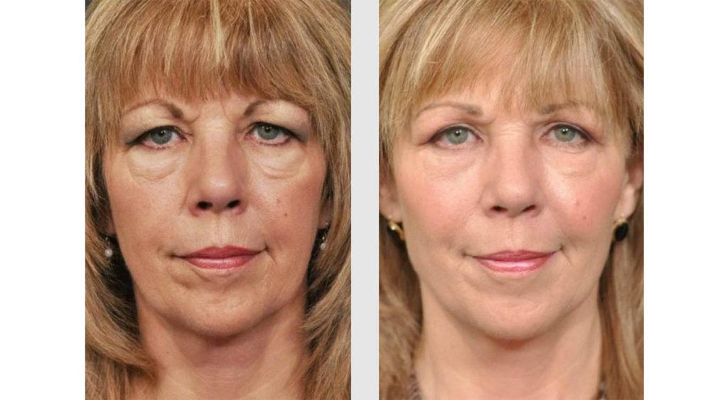 A Before and After photo of Filler injections at Seattle Plastic Surgery in Seattle and Tacoma