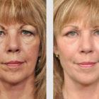 A Before and After photo of Filler injections at Seattle Plastic Surgery in Seattle and Tacoma