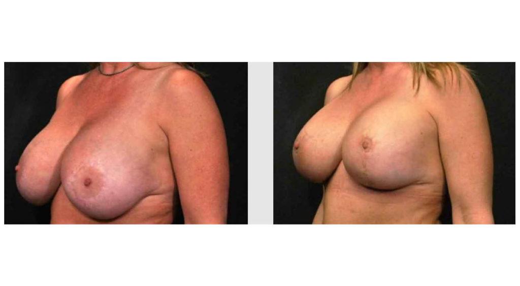 A Before and After photo of a Breast Augmentation Plastic Surgery by Dr. Craig Jonov in Seattle and Tacoma