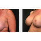 A Before and After photo of a Breast Augmentation Plastic Surgery by Dr. Craig Jonov in Seattle and Tacoma