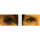 A Before and After photo of Filler injections at Seattle Plastic Surgery in Seattle and Tacoma