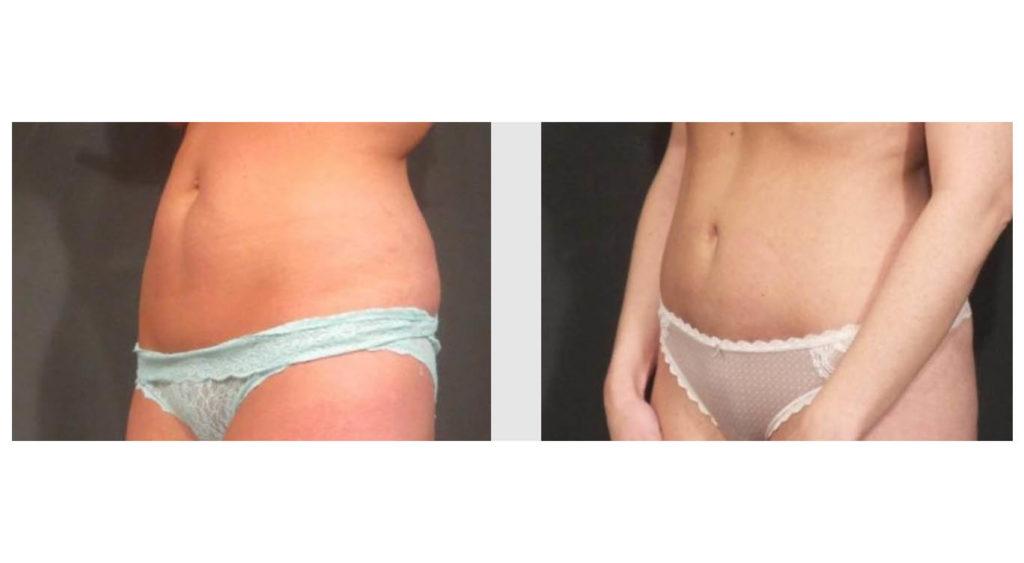 A Before and After photo of a Tummy Tuck Plastic Surgery by Dr. Craig Jonov in Seattle and Tacoma