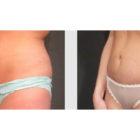 A Before and After photo of a Tummy Tuck Plastic Surgery by Dr. Craig Jonov in Seattle and Tacoma