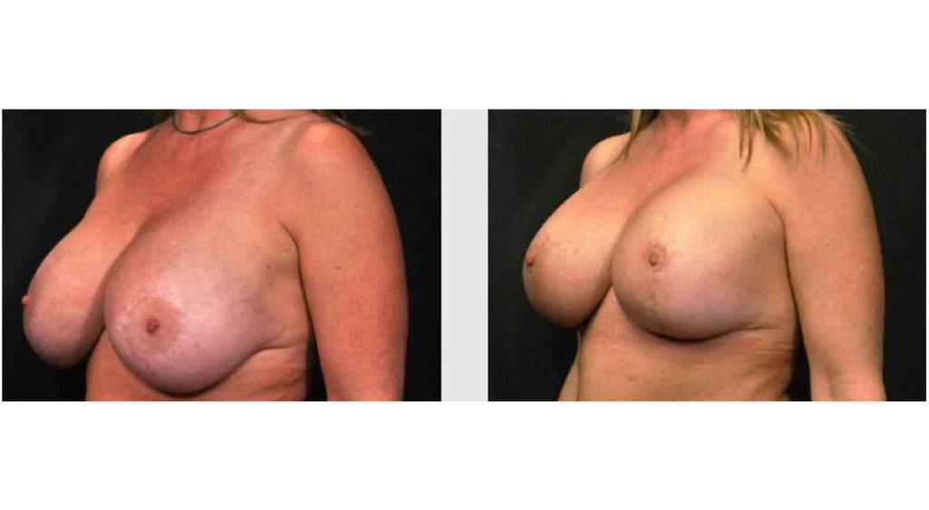 A Before and After photo of a Breast Lift Plastic Surgery by Dr. Craig Jonov in Seattle and Tacoma