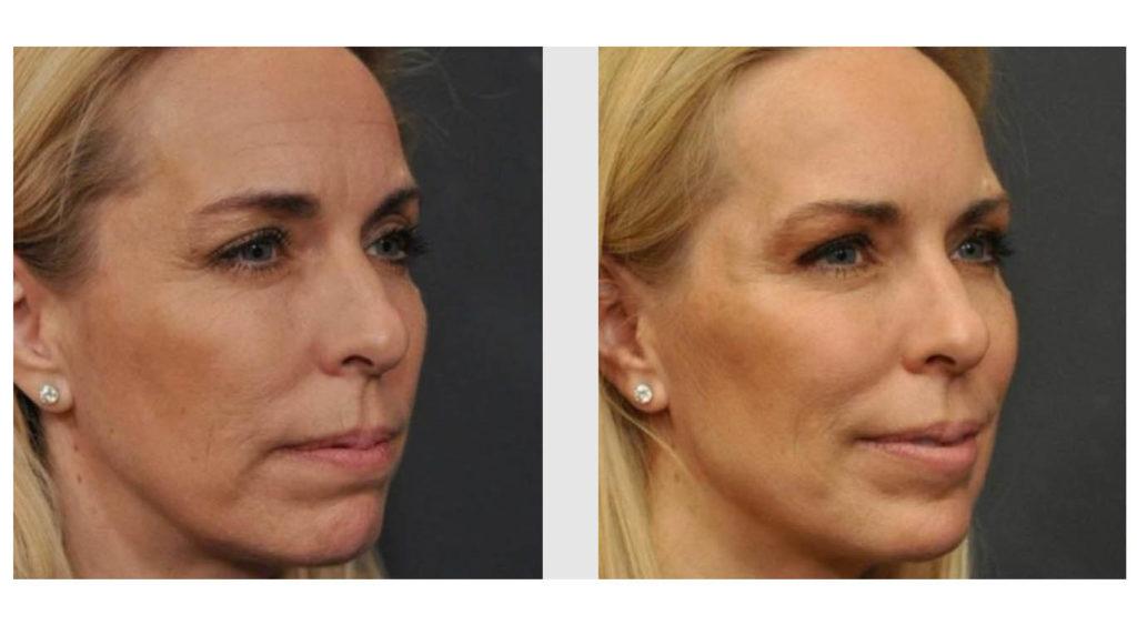 A Before and After photo of Filler injections at Seattle Plastic Surgery in Seattle and Tacoma