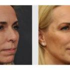 A Before and After photo of Filler injections at Seattle Plastic Surgery in Seattle and Tacoma
