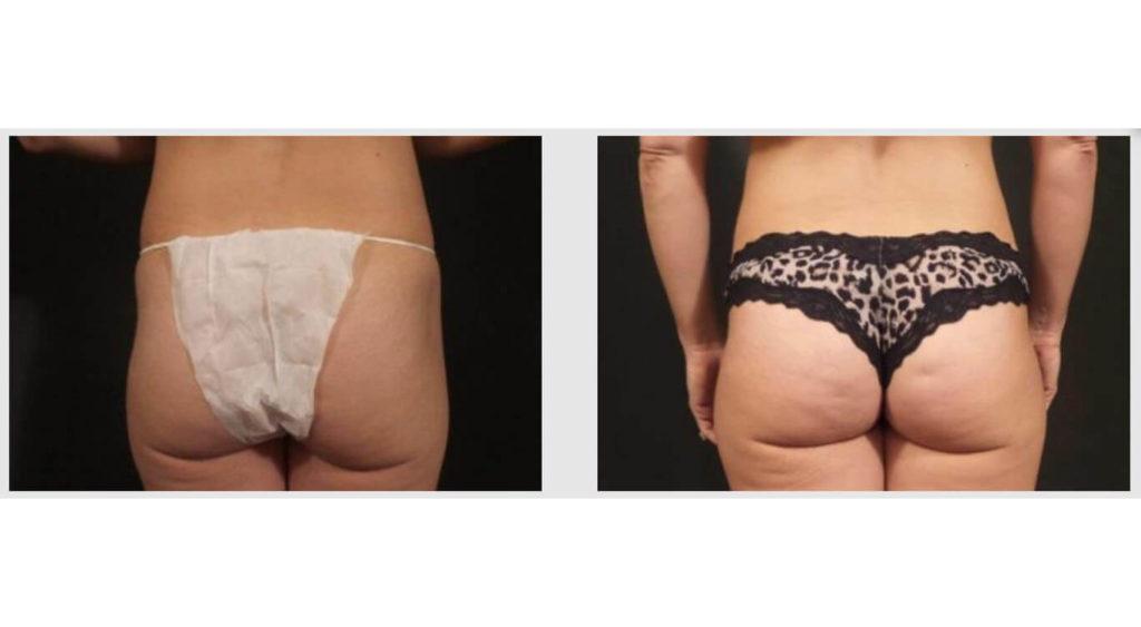 A Before and After photo of a Liposuction Plastic Surgery by Dr. Craig Jonov in Seattle and Tacoma