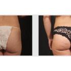 A Before and After photo of a Liposuction Plastic Surgery by Dr. Craig Jonov in Seattle and Tacoma