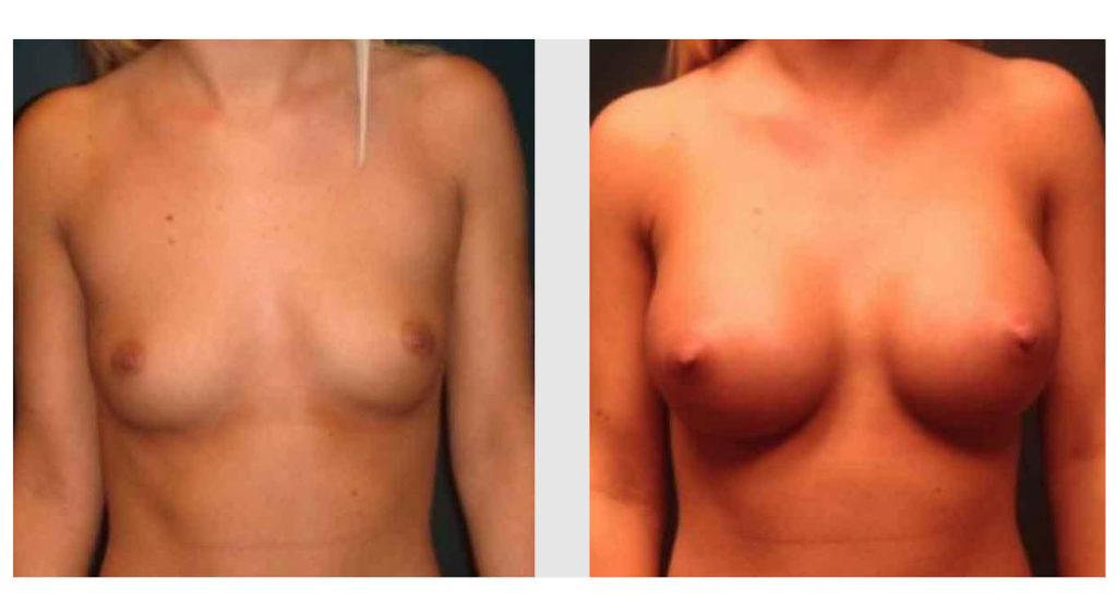 A Before and After photo of a Breast Augmentation Plastic Surgery by Dr. Craig Jonov in Seattle and Tacoma