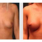 A Before and After photo of a Breast Augmentation Plastic Surgery by Dr. Craig Jonov in Seattle and Tacoma