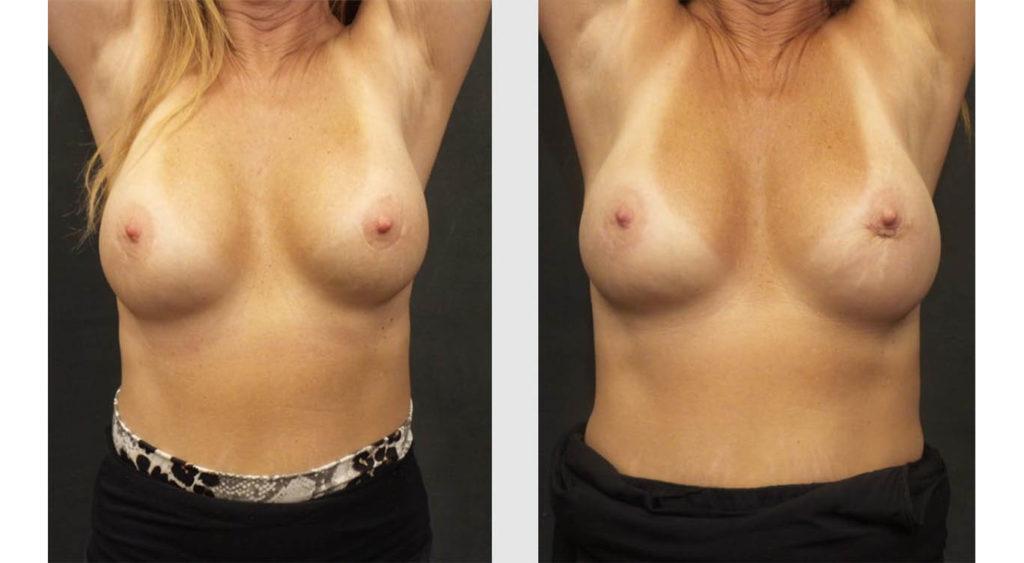 A Before and After photo of a Breast Augmentation Plastic Surgery by Dr. Craig Jonov in Seattle and Tacoma