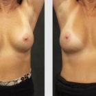 A Before and After photo of a Breast Augmentation Plastic Surgery by Dr. Craig Jonov in Seattle and Tacoma