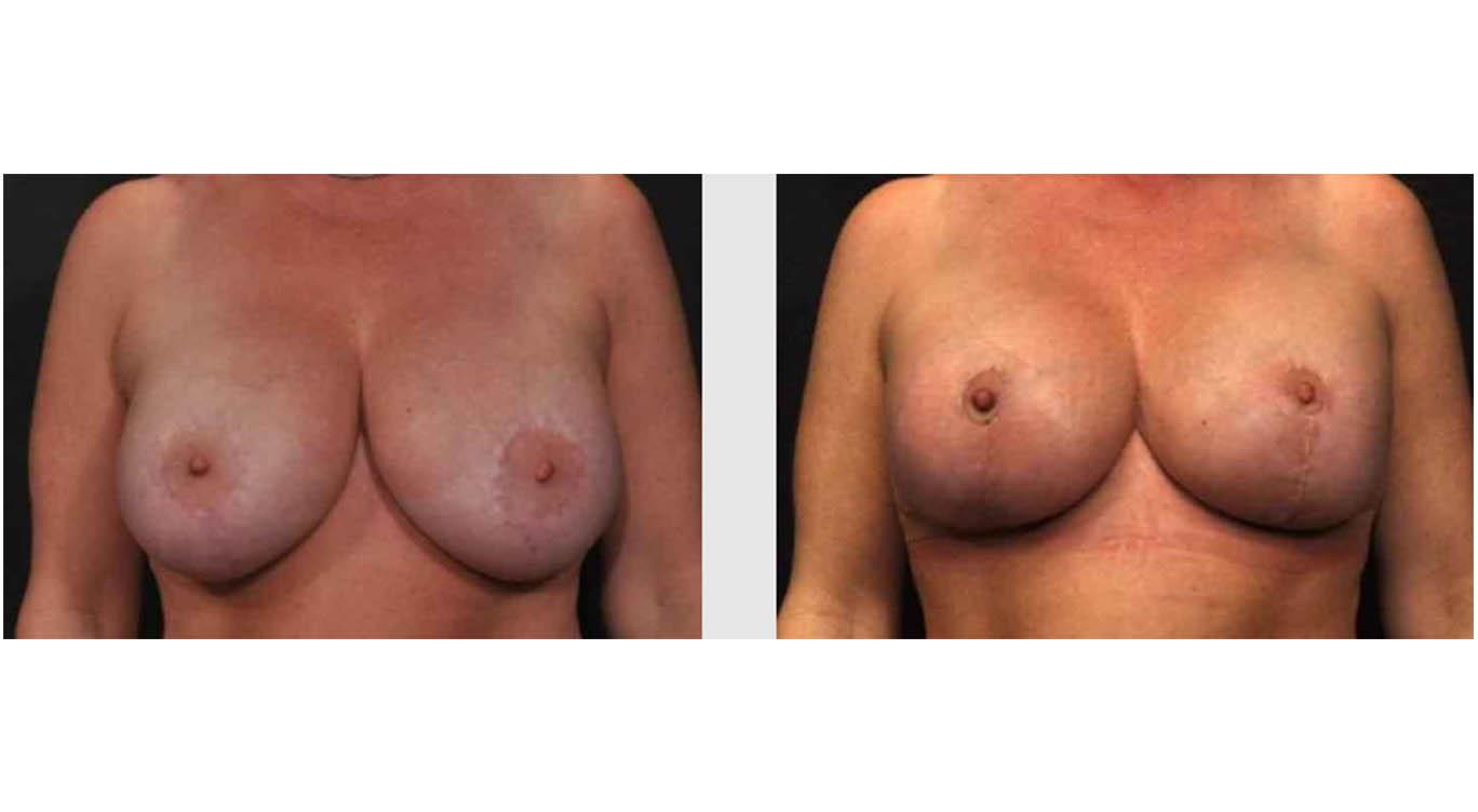 A Before and After photo of a Breast Lift Plastic Surgery by Dr. Craig Jonov in Seattle and Tacoma