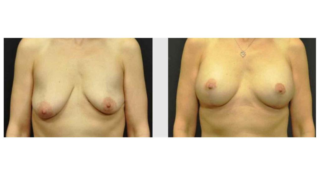 A Before and After photo of a Breast Augmentation Plastic Surgery by Dr. Craig Jonov in Seattle and Tacoma