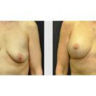 A Before and After photo of a Breast Augmentation Plastic Surgery by Dr. Craig Jonov in Seattle and Tacoma