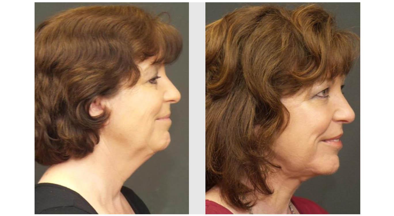 A Before and After photo of a SwiftLift Plastic Surgery by Dr. Craig Jonov in Seattle and Tacoma